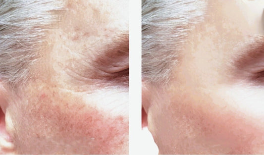 VCLINICA® Hyaluronic Acid Moisturizer with Retinol, Vit C & E, Aloe Vera & Shea Butter 2 Ounce/60ml