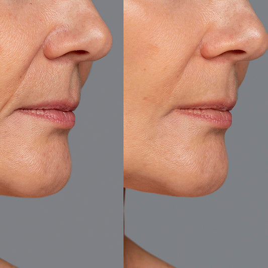 VCLINICA® Hyaluronic Acid Hi-C,E Antioxidant Firming Serum - 30ml/1 floz